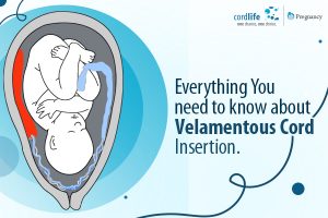 Everything You Need to Know About Velamentous Cord Insertion