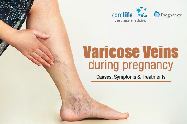 2022] Prevention Of Varicose Veins During Pregnancy?