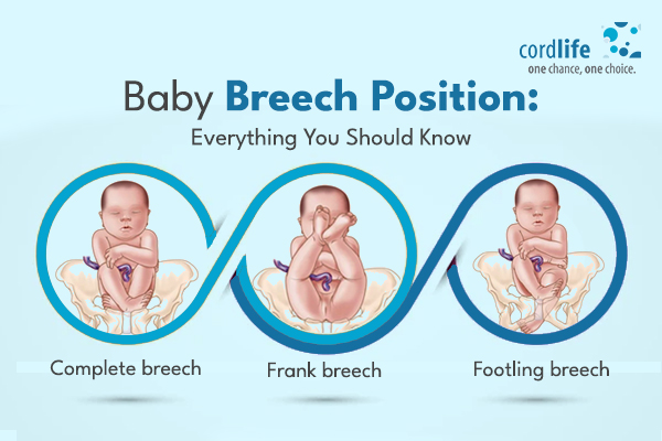 breech baby positions